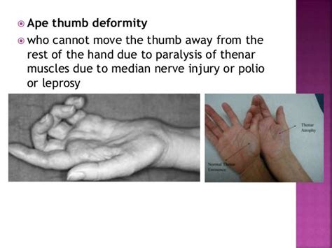 ape thumb deformity  publish