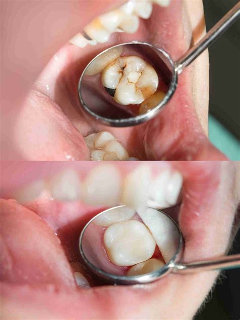 Composite Fillings – Straits Area Dental