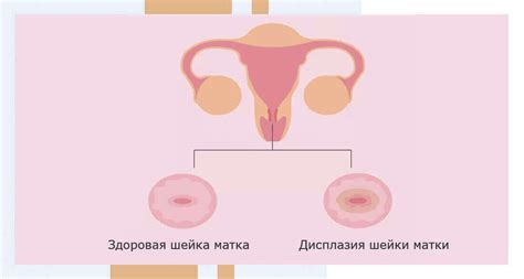 Дисплазия шейки матки 3 степени: причины, симптомы, диагностика и ...