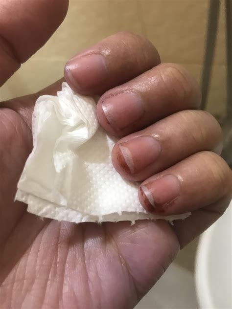 skin around nails became itchy, painful, and now the small watery humps