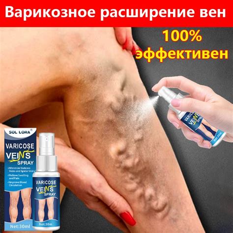 Спрей от варикоза 30 мл разглаживает сосуды ухаживает за кожей ...