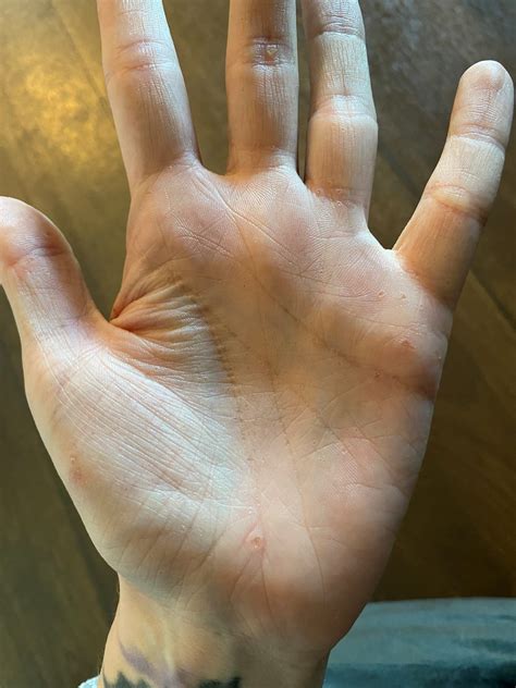 AAGAB-pEDD (palmoplantar Epidermal Differentiation Disorder)