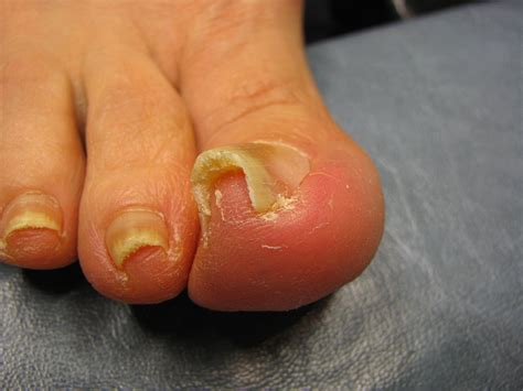 Why Are My Toenails Curved at Jack Oneill blog