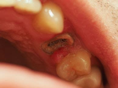 Retained Root | Quek And Me Dental