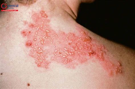 Bệnh Zona thần kinh: nguyên nhân, chẩn đoán và điều trị