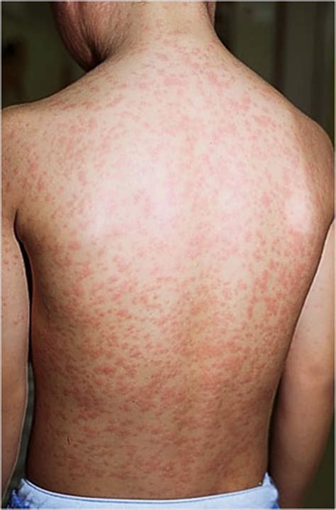 Measles Rash Images To Help Identify Symptoms as Virus Spreads in US