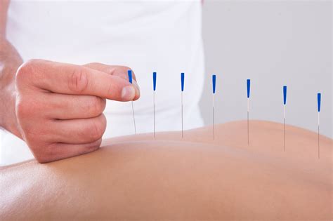 Top 5 Benefits of Acupuncture