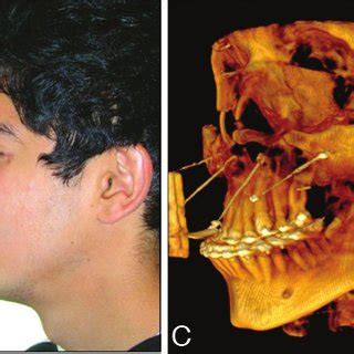 Segmental osteotomy distraction osteogenesis with a hyrax screw device ...