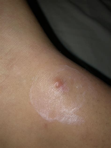 did i get bit by a spider????? ive been itchy and irritant for days and