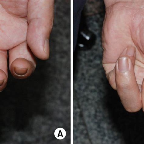 (A) The rotational deformity of the 4th finger nail plate was noted ...
