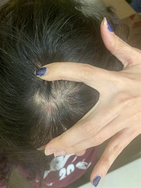 My dandruff is not going away and now what are these???!! : r/dandruff