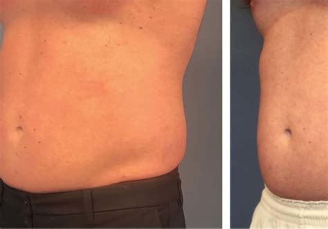 how long does it take for coolsculpting to work