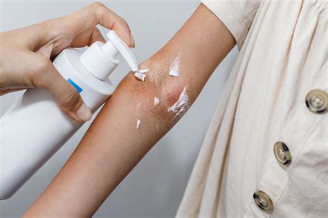 The Impact of Anti-Inflammatory Moisturizers in Mild to Moderate Atopic