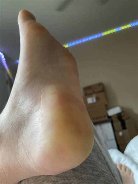 Discoloration On Heel Of Foot Sale | emergencydentistry.com