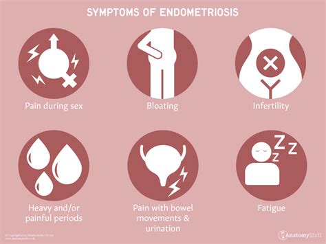 Endometriosis Symptoms
