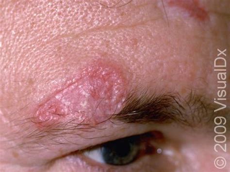 Discoid Lupus Erythematosus