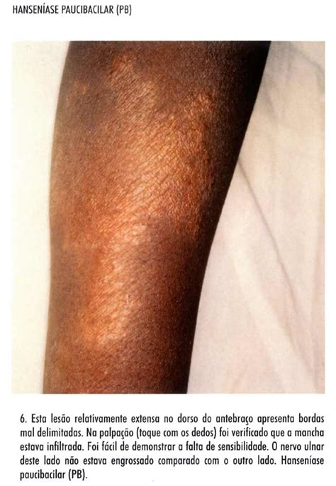atlas  leprosy