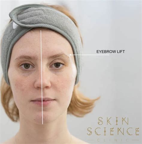 Hooded Eyelids | Skin Science Clinic London