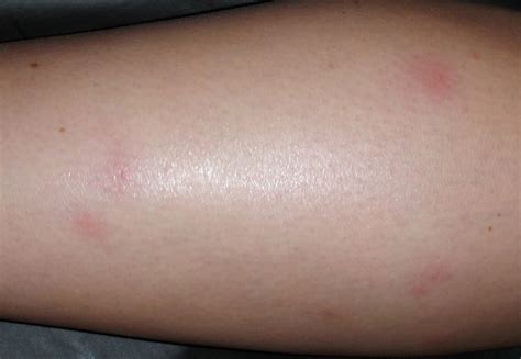 Show Pictures Of Bed Bug Bites On Humans - Infoupdate.org