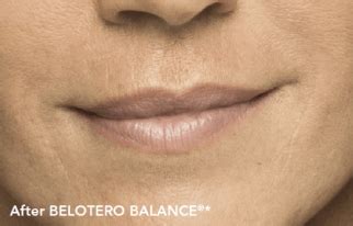 Belotero filler – Case 1 - SkinCare Physicians