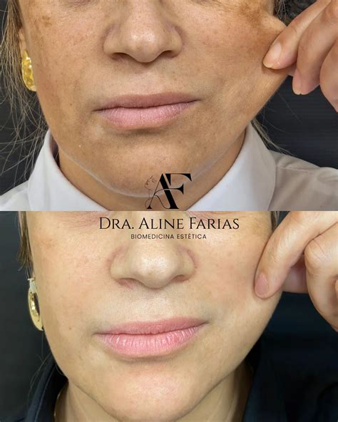 Dra. Aline Farias | Harmonização Facial e Corporal (@dra