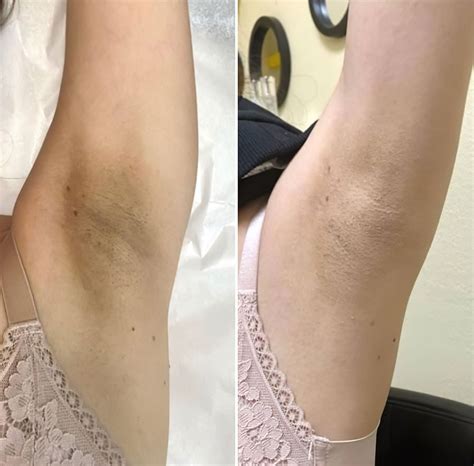 Skin Bleaching in Las Vegas | Lighten Skin & Reduce Dark Spots
