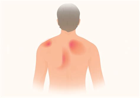 What Causes Shoulder And Lower Back Pain - Infoupdate.org