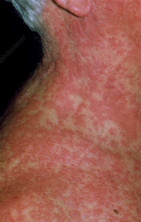 Allergic Reaction Rash On Neck