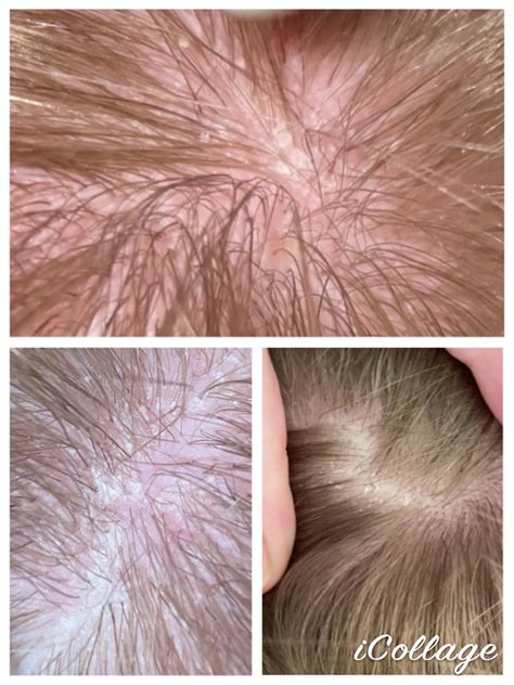 Have had this issue for years. I’ve tried cortisone, organic shampoo