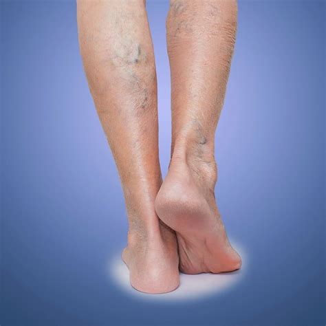 Treatment Options for Varicose Veins | Midwest Radiology
