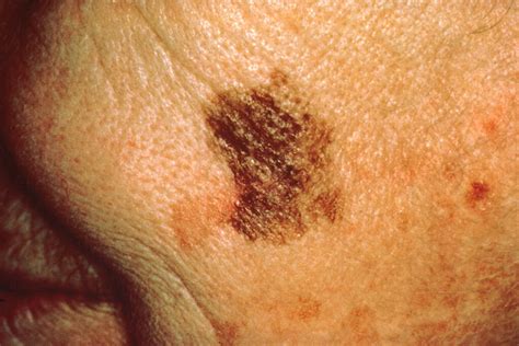 What’s the Biggest that Melanoma In Situ Can Grow? » Scary Symptoms