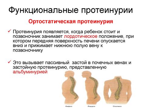 Современная диагностика протеинурии - презентация онлайн