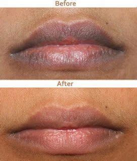 dark lips treatment   price   delhi  shine smile