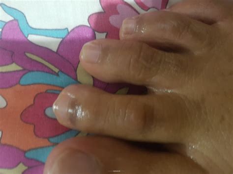 Ask a Dermatologist Online for Spots On Feet