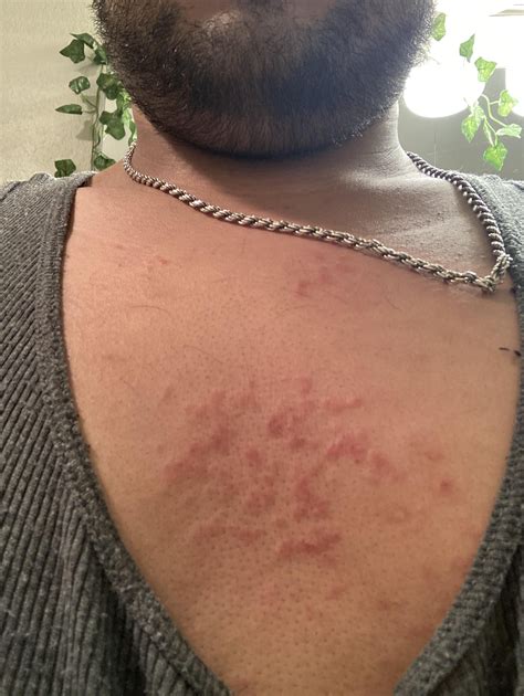 Autophagy rash? : r/Water_Fasting