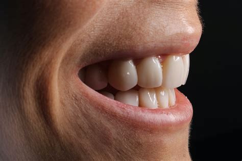Cuidado de las carillas dentales - Tecnidental