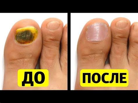 Копеечное сильнейшее средство от грибка ногтей// Как Вылечить Грибок на ...