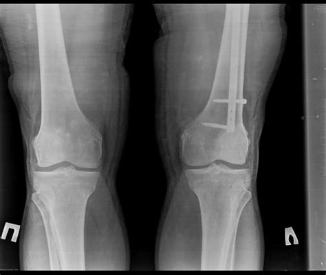 patella biparita? | Портал радиологов