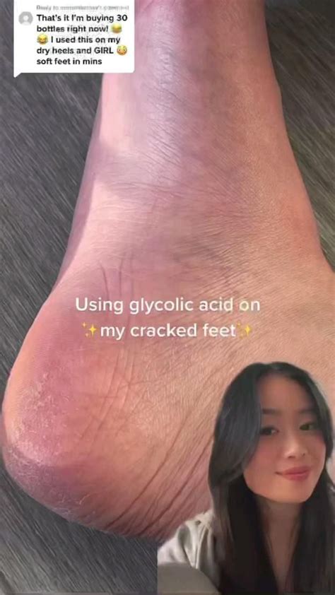 care   cracked feet body exfoliator feet care