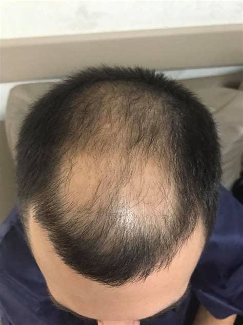 Пин от пользователя Real Trans Hair на доске Пересадка волос До-После ...