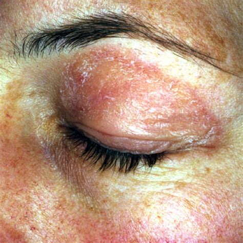 Dermatomyositis Face