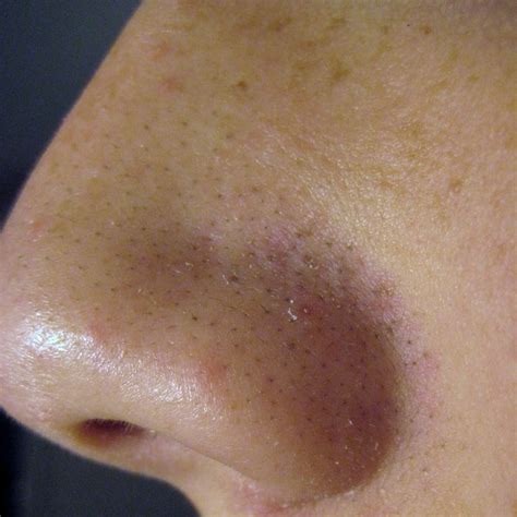 Blackheads and Large Pores — Advanced Dermatology