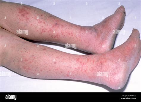 Meningococcal rash hi-res stock photography and images - Alamy