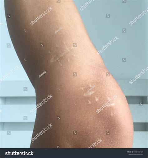 Acl Surgery Recovery Scared Stock Photo 1445739467 | Shutterstock