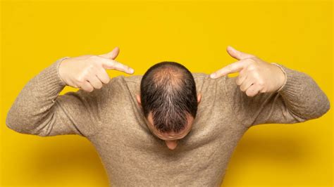 What is Non-Scarring Alopecia? Causes, Symptoms & More