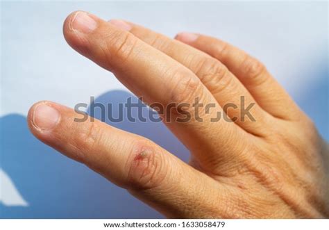 Woman Peeled Index Finger Scar Skin Stock Photo 1633058479 | Shutterstock