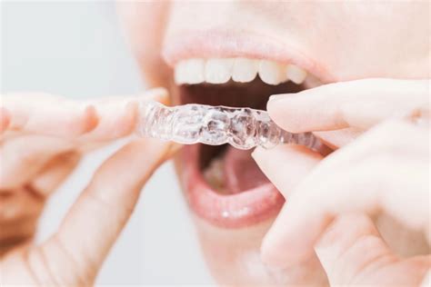 Капы для прикуса: исправляем зубы комфортно и эффективно | 3D-Smile