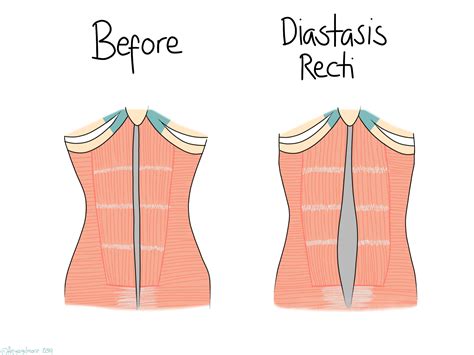 Diastasis Recti — | Naas Osteopaths | Kildare Osteopath | Children's