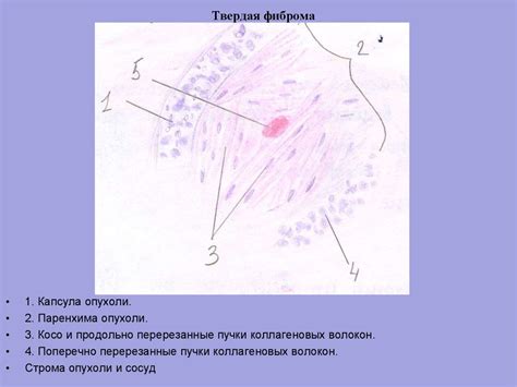 Фиброма - презентация онлайн