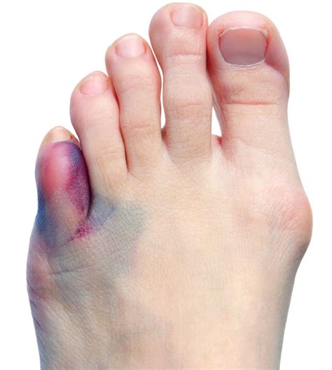 Swollen Painful Toe - Causes, Symptoms & 5 Best Treatment